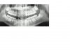 tooth x rayresize.jpg
