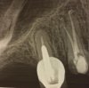 mc root canals xray.jpg