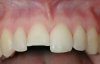 crown-fracture-emanel-dentin1.jpg