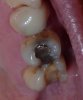 No Fill UL6 Molar.jpg