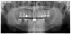 Hui Full Mouth xray.jpeg