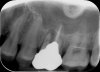 Upper left 6th tooth.jpg