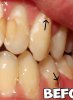 Upper left canine and lower left premolar.jpg