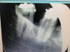 Wisdom Tooth X-ray--me.jpg
