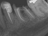 Crown tooth 2.jpg