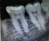 tooth 20 x-ray.jpeg