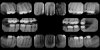 Polatchek, Ezriel 06_08_2020 Intraoral Full Mouth Images.jpeg