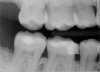 Molar 3.jpg