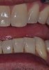 BottomTeeth-Before-Aug20-3.jpg