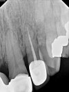 tooth-temp-2.jpg