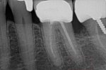 Periapical Tooth 19.jpg