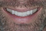 Justin-Veneers-For-Men-S3-Post-6084.jpg