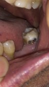 Deep decay No.18 Molar pre-restoration.jpg