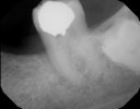 No.18 periapical July 2021.jpg