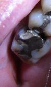 6 year molar.jpg