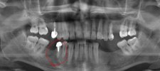 capture tooth 26 xray.JPG