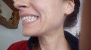 8 - present day, after 2nd dentist appontment, gums still red and inflamed.jpg
