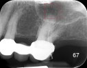 Periapical.JPG