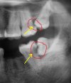 X-Ray-of-Top-and-Bottom-Impacted-Wisdom-Teeth-257x300.jpg