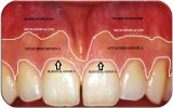 Marginal-free-gingiva-attached-gingiva-and-alveolar-mucosa.jpeg