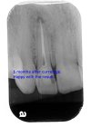 4422b 16-03-2013 after RCT and periapical curettage.JPG