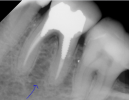 tooth xray.PNG