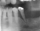 Loose tooth.jpg