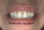 Front smile post chip centre.jpg