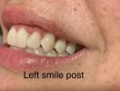 Left smile post.jpg