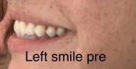 Left smile pre.jpg