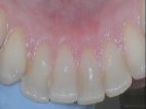 front teeth april (1).jpg