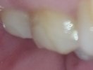 Pic, 2nd molar, top left, lingual, 7th Nov '24.jpg