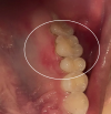 Painful Spot on Roof of Mouth.png